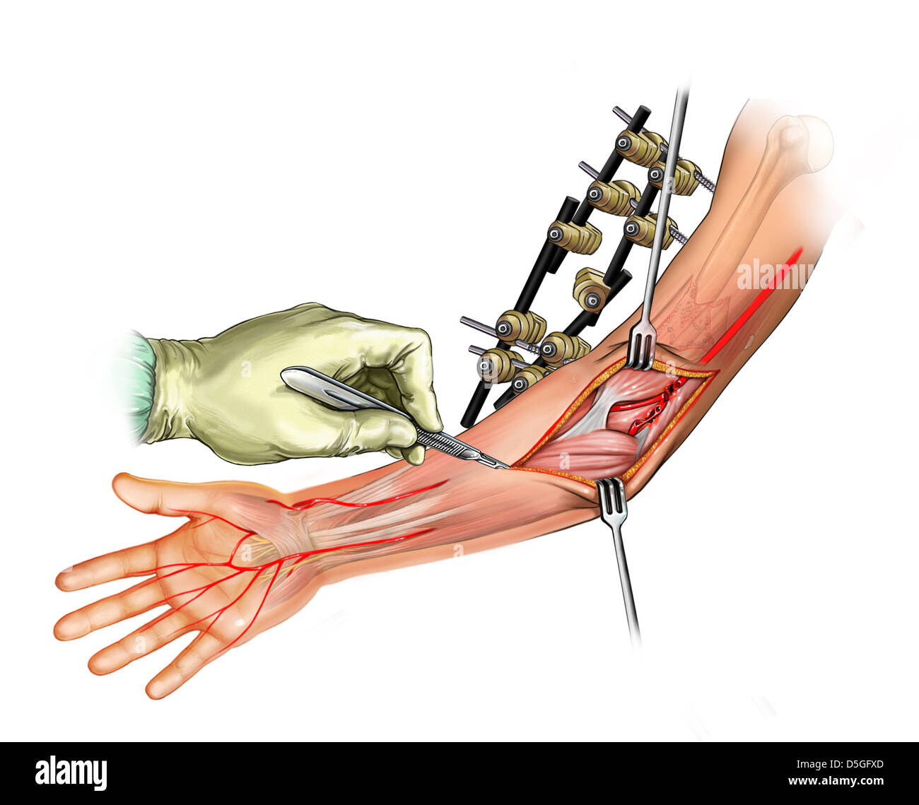 Injury to the Arteries of the Arm Stock Photo Alamy
