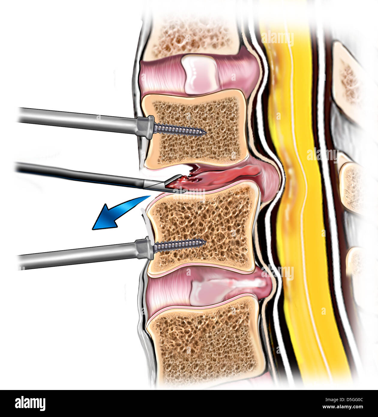Bone Fusion Process Fusion of the vertebrae hi-res stock photography and images - Alamy