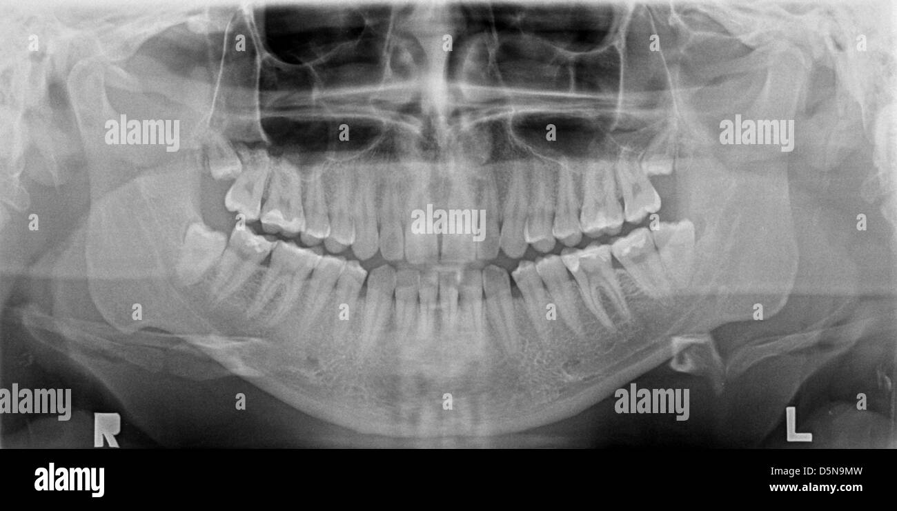 Panoramic x-ray image of teeth. Problem with wisdom tooth. Stock Photo