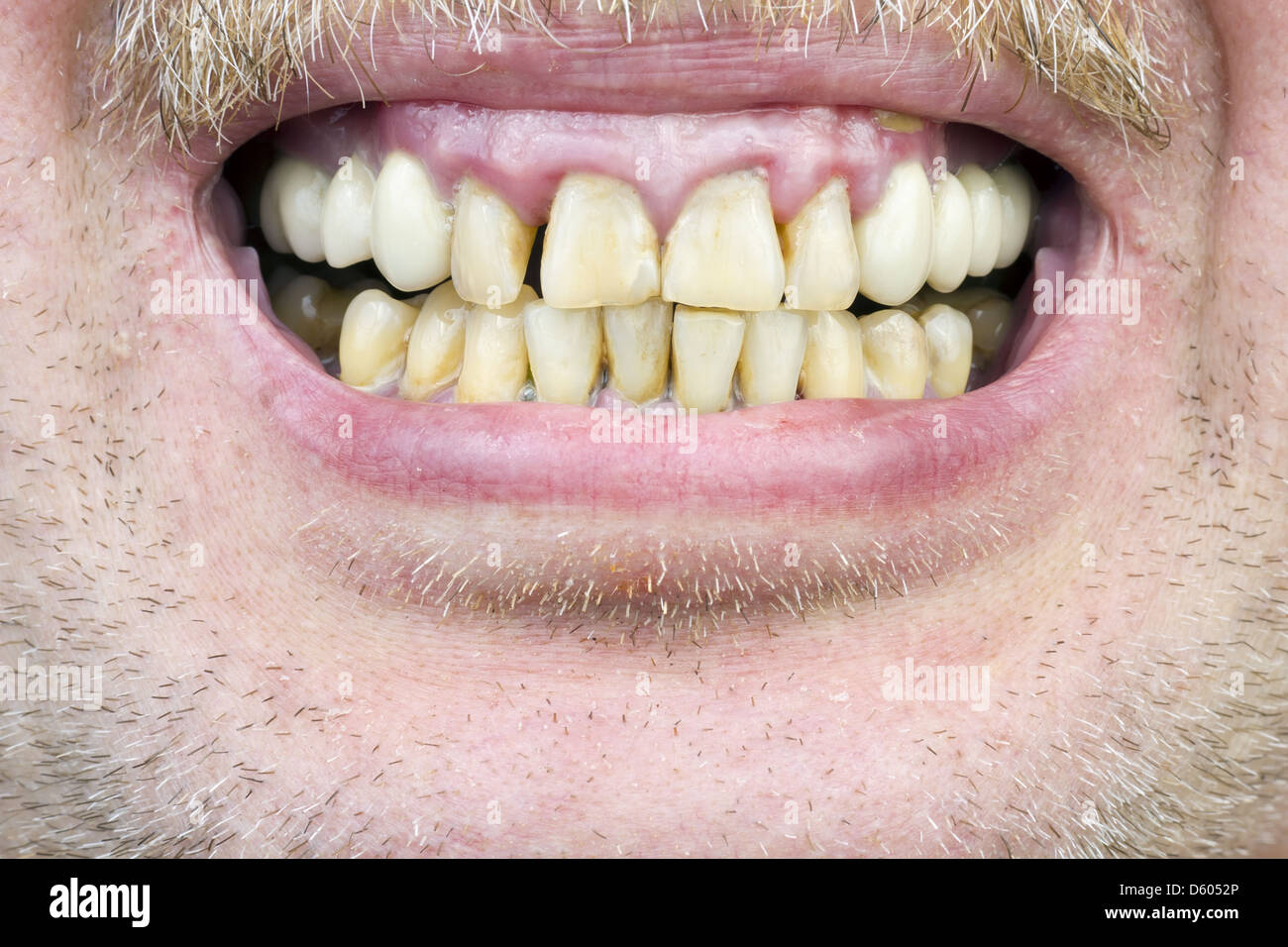 Yellow teeth hires stock photography and images Alamy