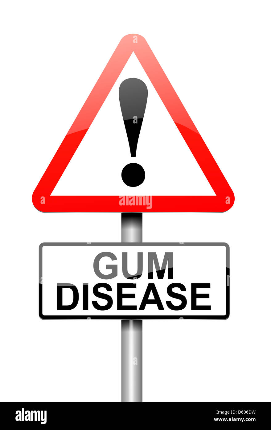 Gum disease. Stock Photo