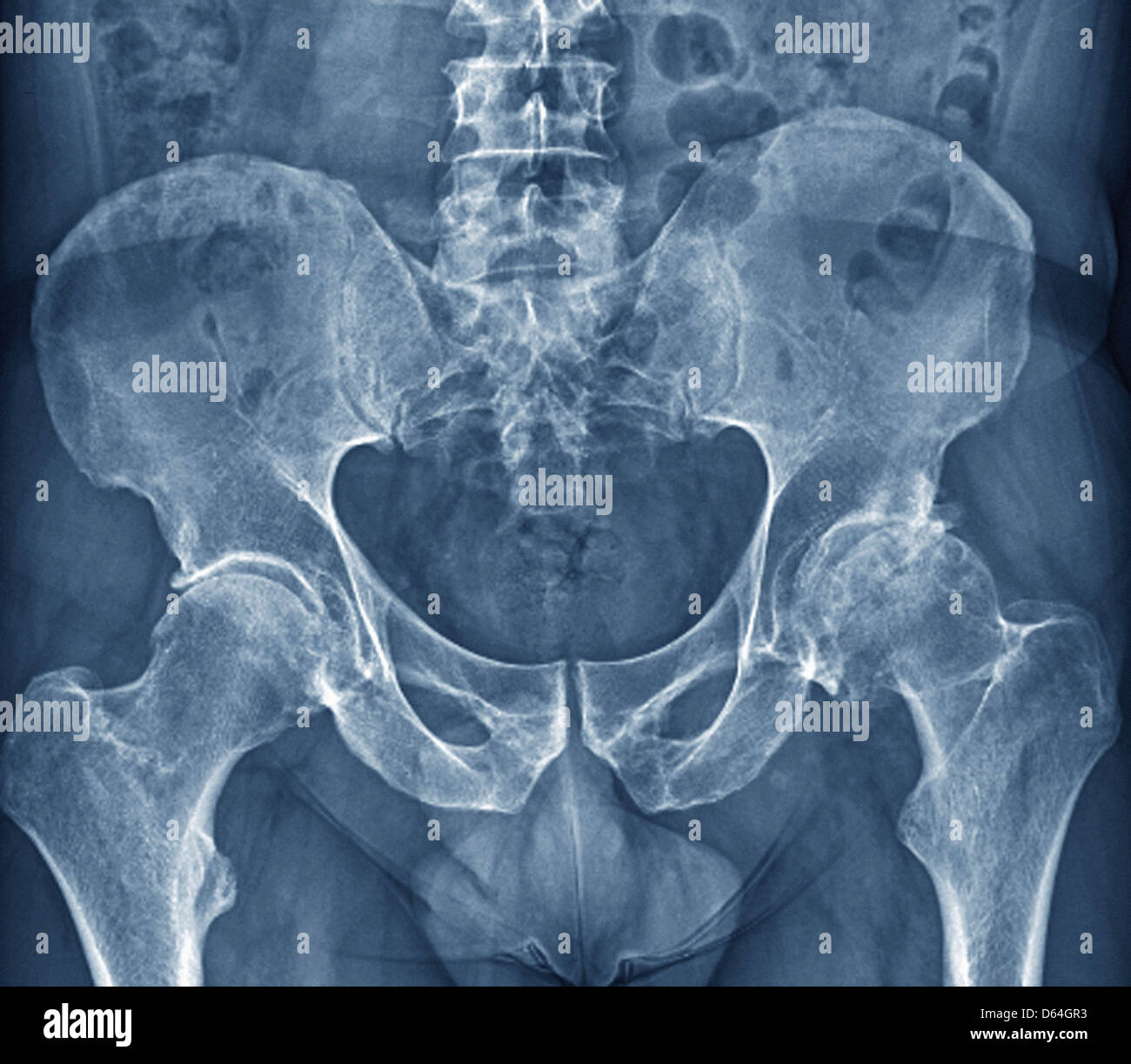 Osteoarthritis of the hip, X-ray Stock Photo