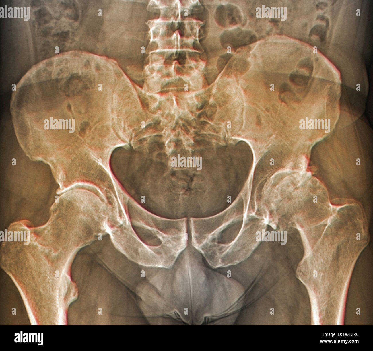 Osteoarthritis of the hip, X-ray Stock Photo