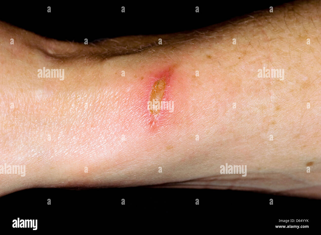 Infected burn Stock Photo