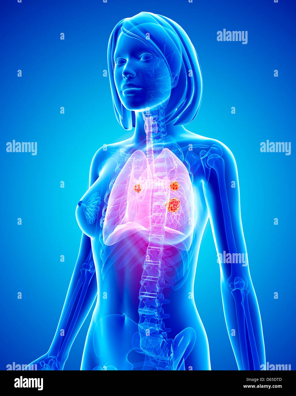 Female lung cancer, artwork Stock Photo