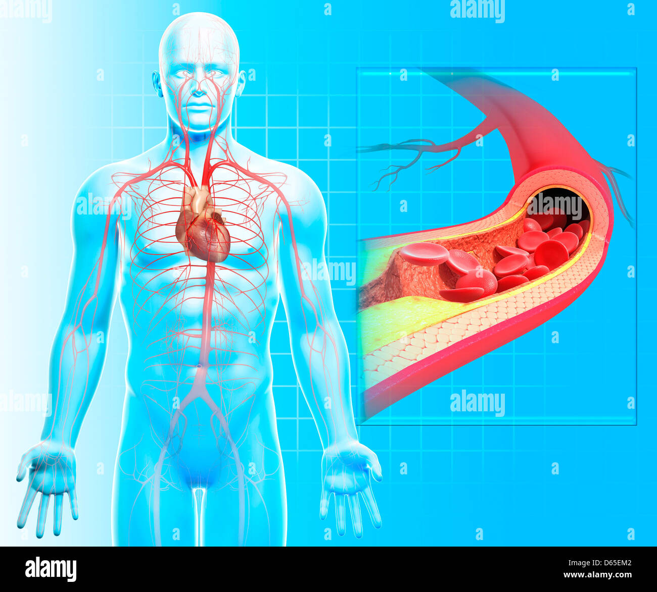 Carotid atherosclerosis hi-res stock photography and images - Alamy