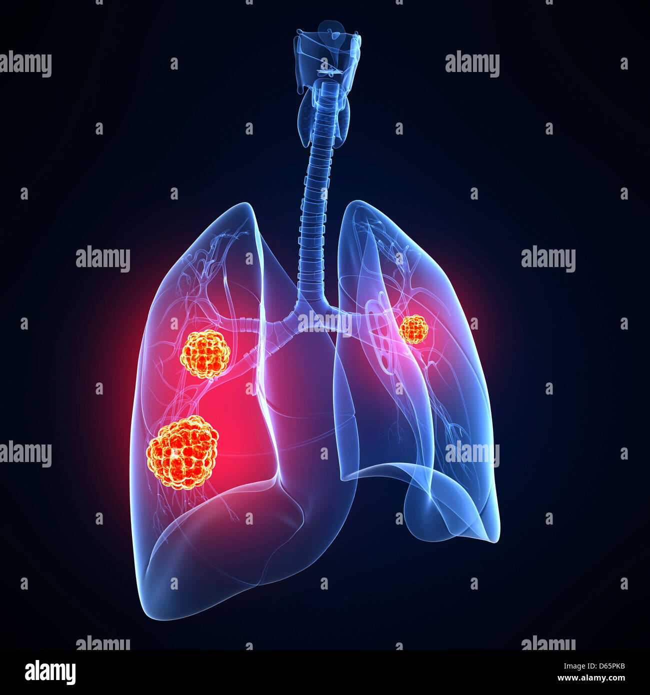 Lung cancer, artwork Stock Photo