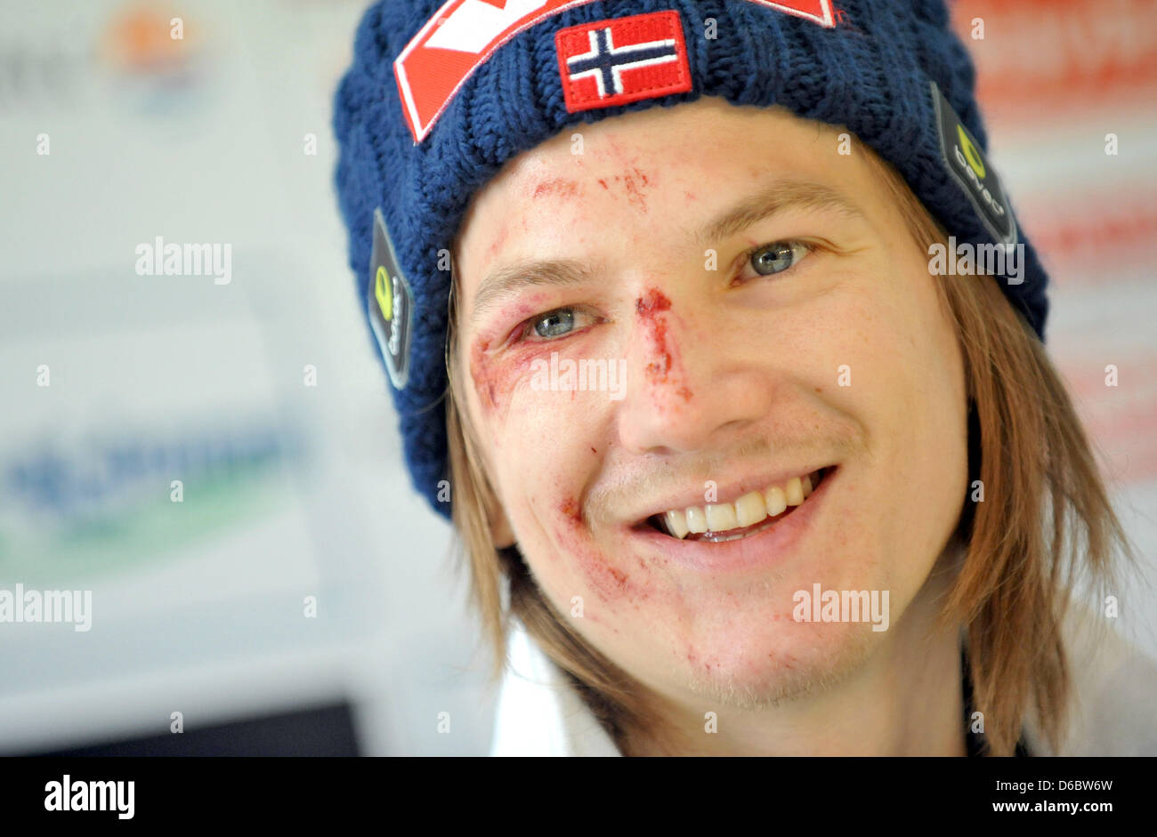 Norwegian ski jumper Tom Hilde is present at a press conference in  Garmisch-Partenkirchen, Germany, 01 January 2012. Hilde crashed hard during  the opening jumping competition of the 60th Four Hills Tournament in