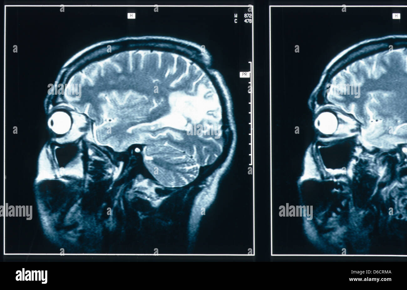 Berlin, Germany, MRI scan of a human head Stock Photo Alamy