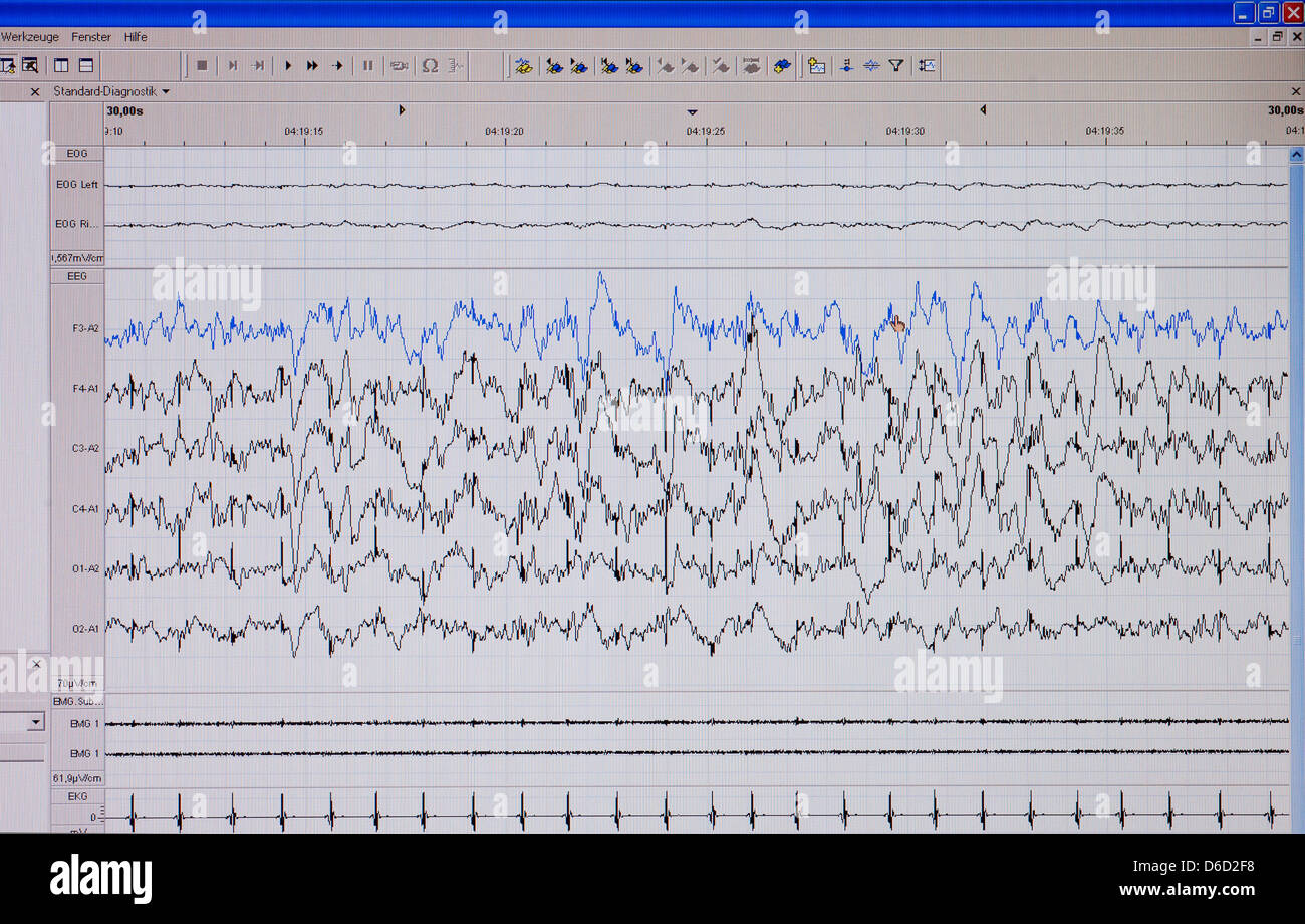 Berlin, Germany, polysomnogram on the screen of a computer in the sleep laboratory Stock Photo