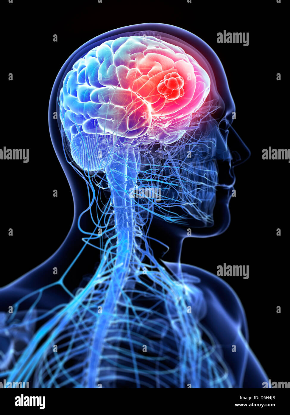 Brain cancer, artwork Stock Photo