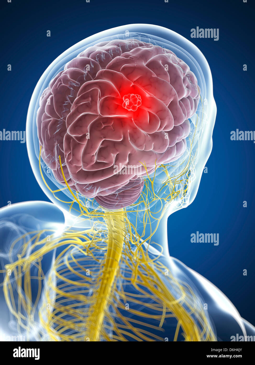 Brain cancer, artwork Stock Photo