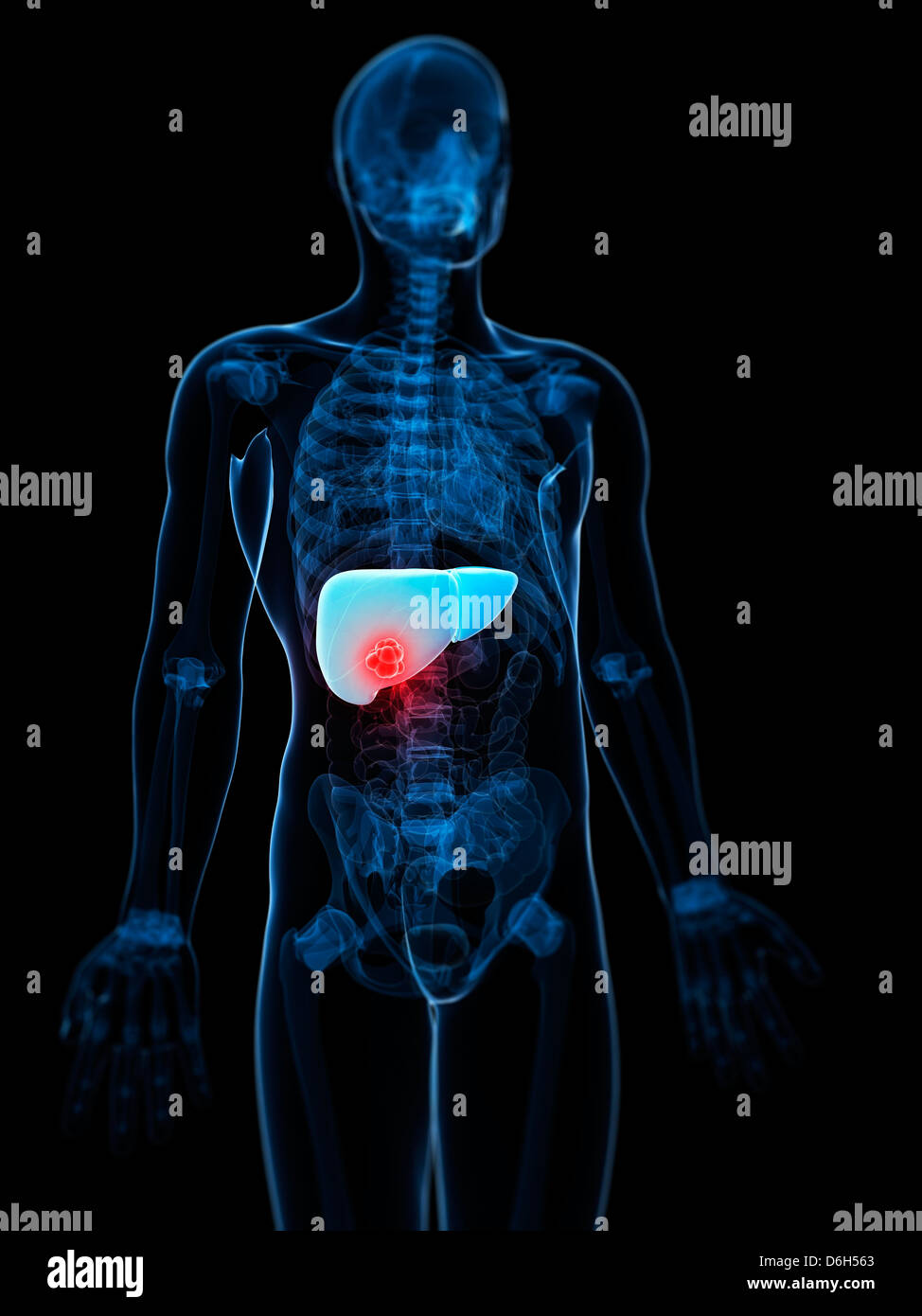 Liver cancer hi-res stock photography and images - Alamy