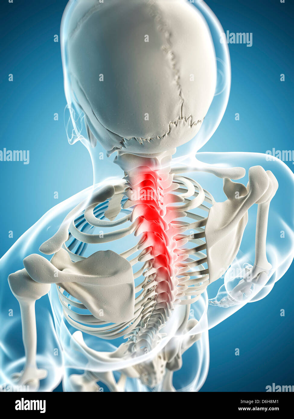 Neck pain, conceptual artwork Stock Photo - Alamy