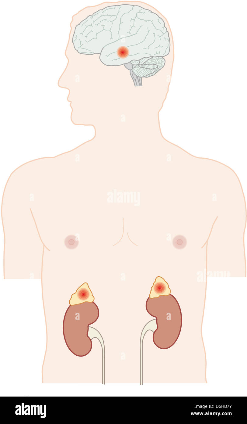 Addison’s disease hi-res stock photography and images - Alamy