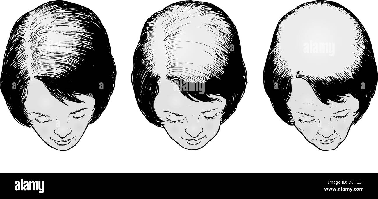 Hair loss in women Stock Photo Alamy