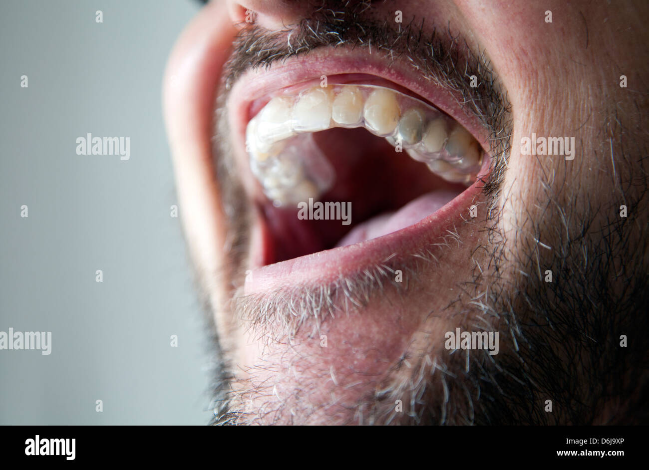 Gum shield hires stock photography and images Alamy