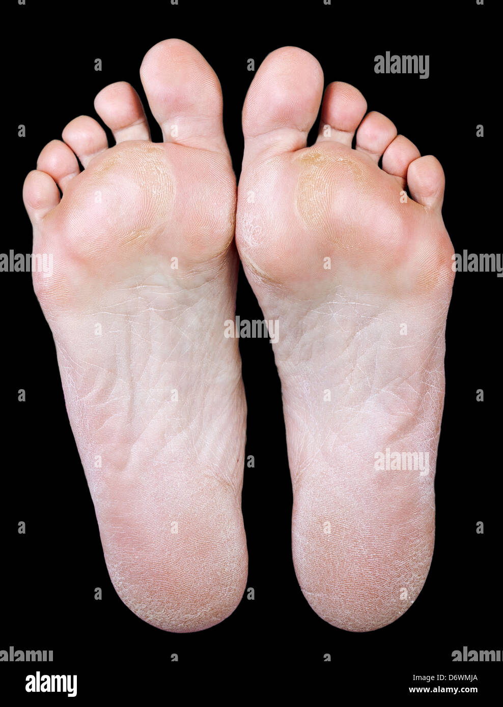 The underside of the foot of an old woman with calluses on black background Stock Photo Alamy