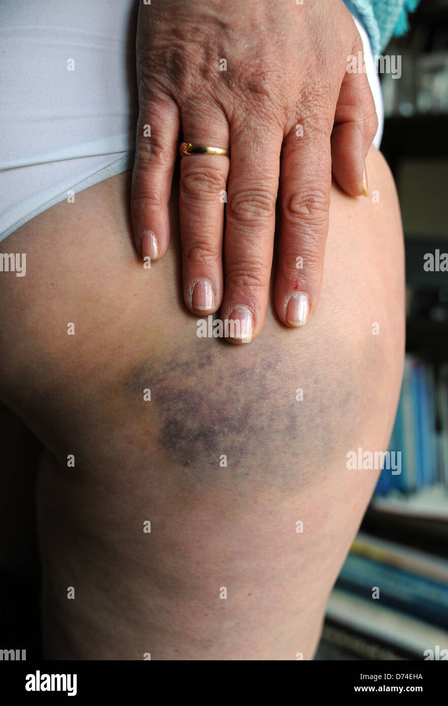 Woman shows injury with heavy bruising to skin on upper thigh area of leg after a fall Stock Photo