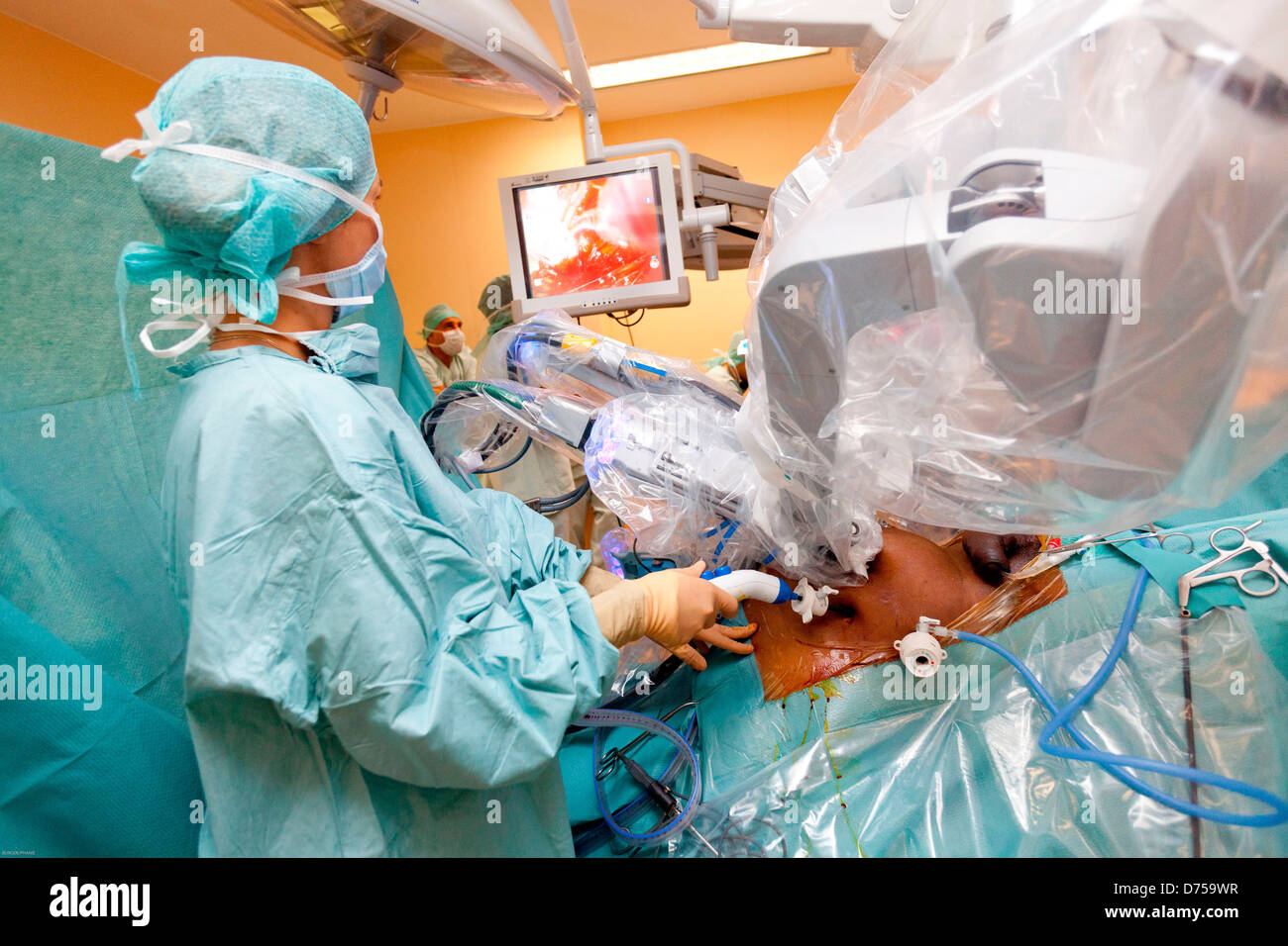 Prostatectomy performed by telesurgery robot Da Vinci which four