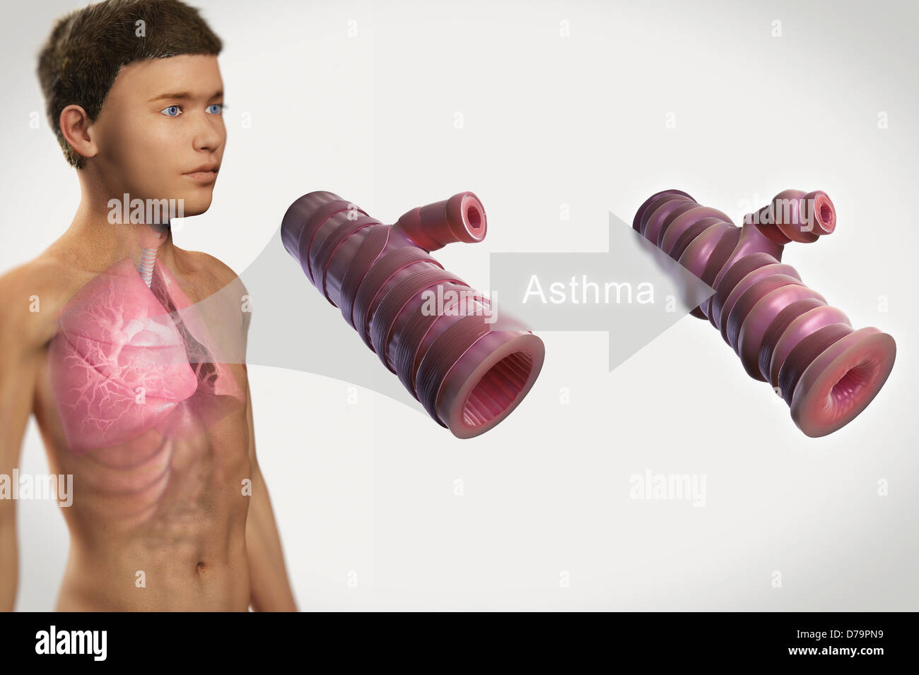 Asthmatic Airway Stock Photo