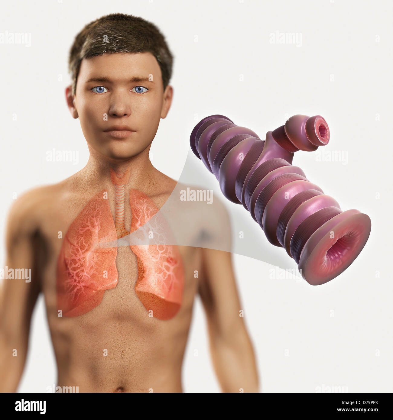 Asthmatic Airway Stock Photo