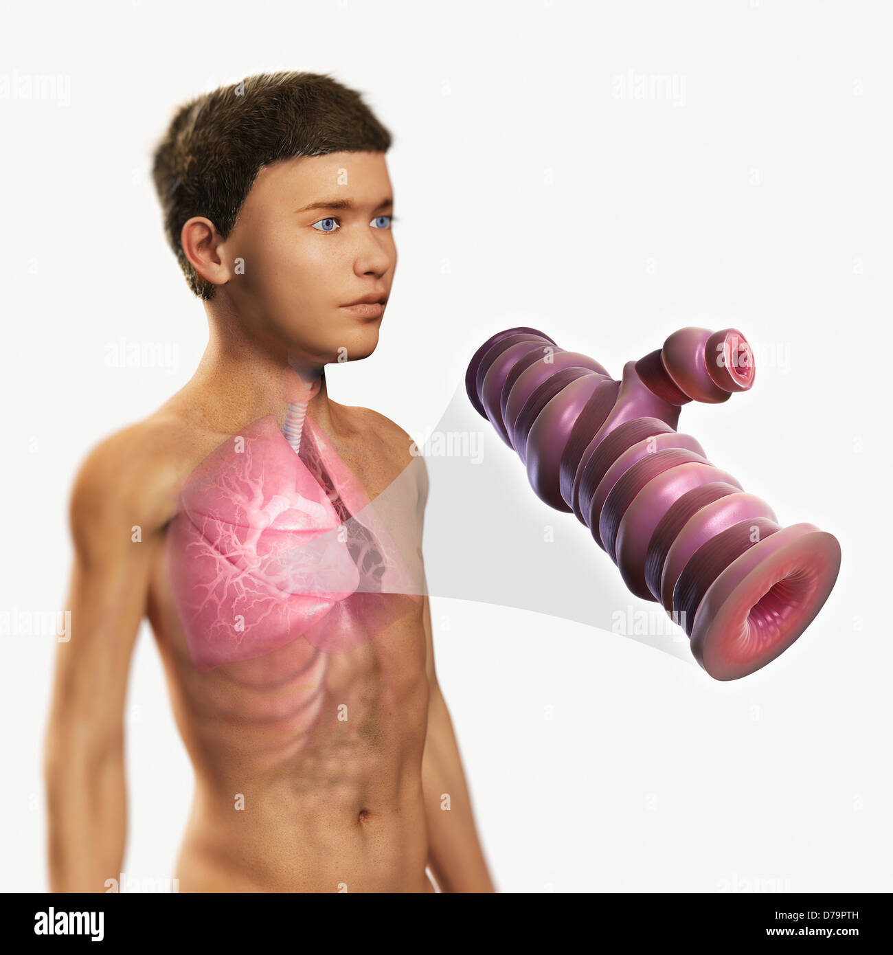 Asthmatic Airway Stock Photo