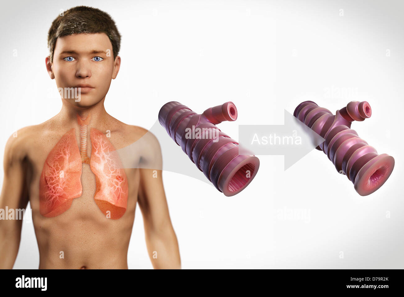 Asthmatic Airway Stock Photo