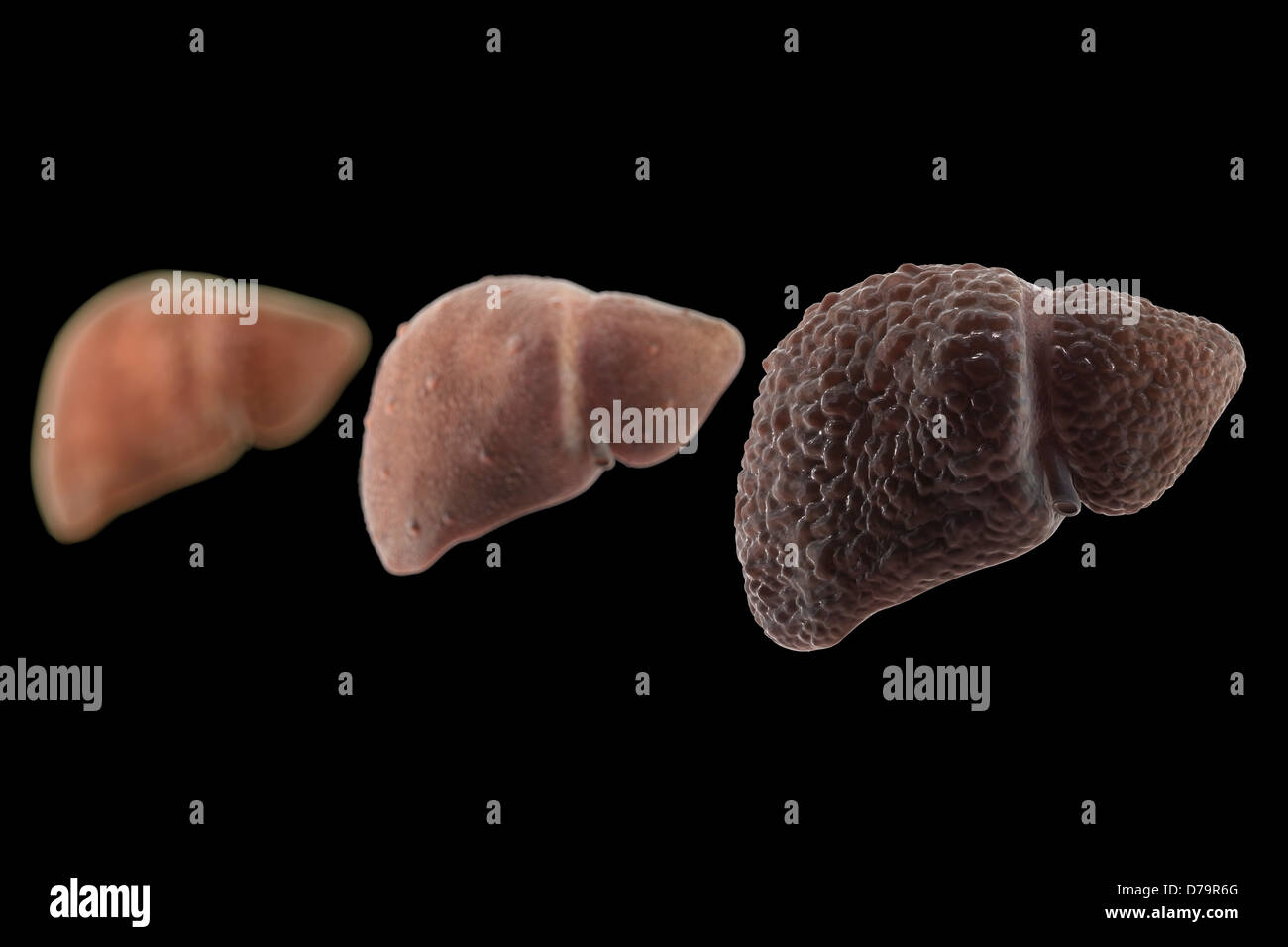 Stages Liver Disease Stock Photo - Alamy