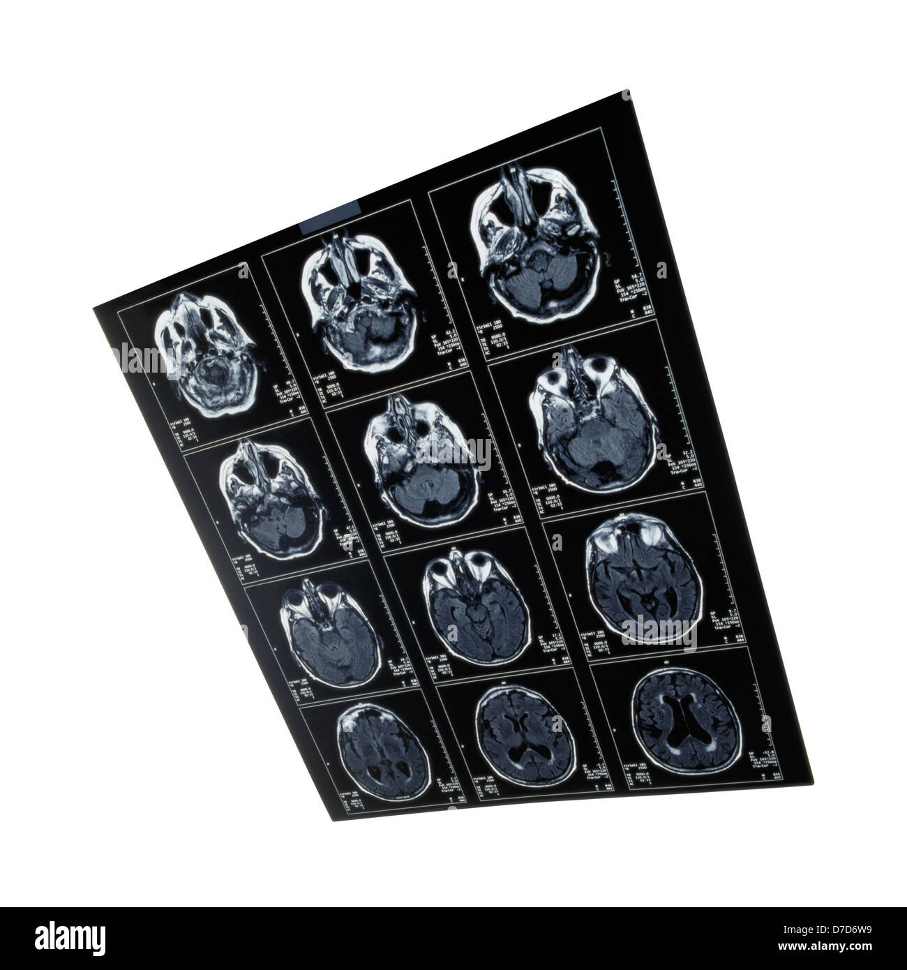 X-ray image of the brain computed tomography Stock Photo