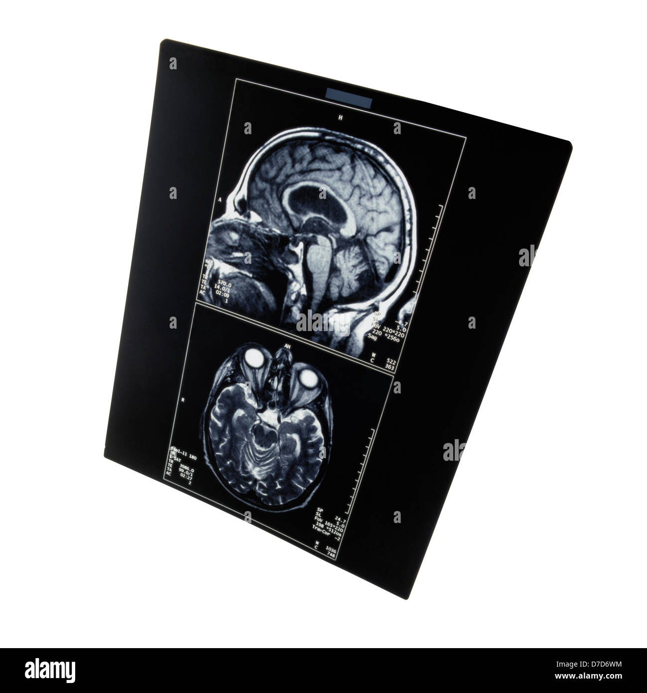 X-ray image of the brain computed tomography Stock Photo