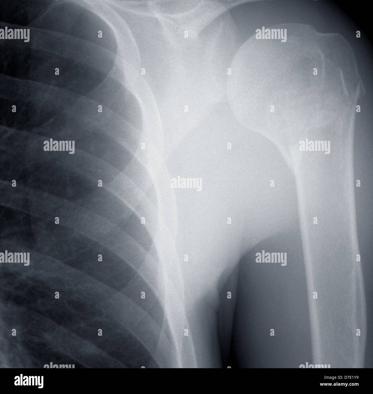 Humerus Stock Photos & Humerus Stock Images - Alamy