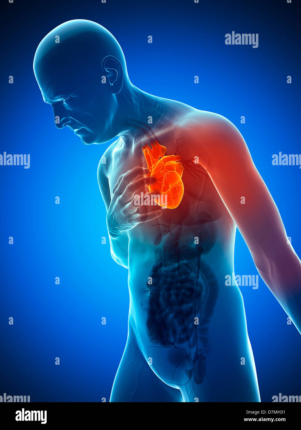 Heart attack, artwork Stock Photo Alamy