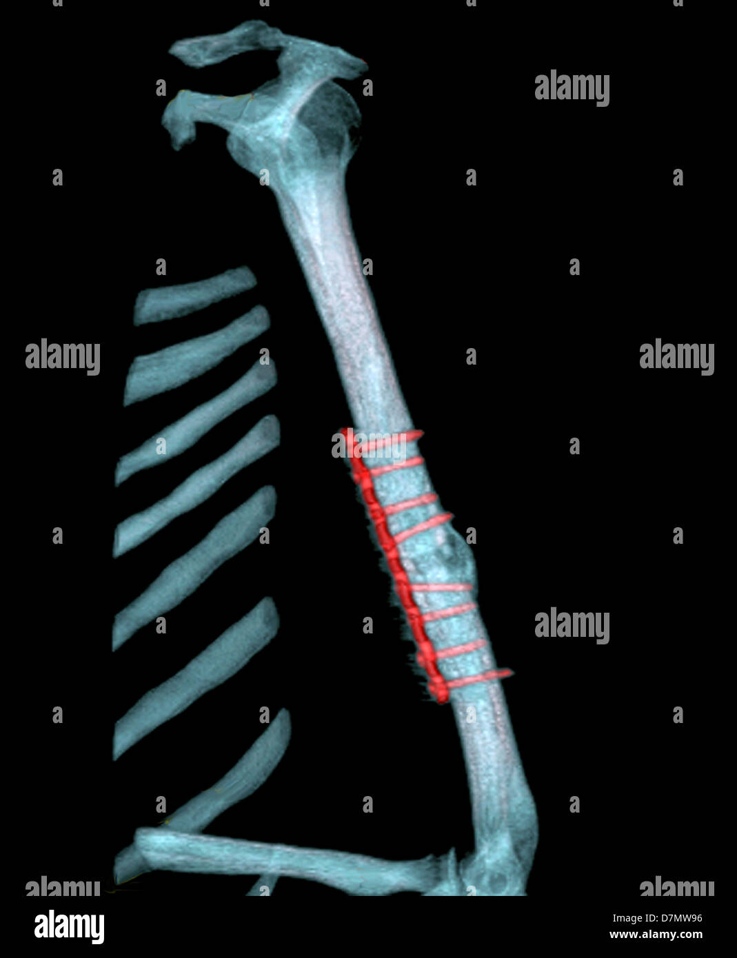 Pinned arm fracture, 3D CT scan Stock Photo