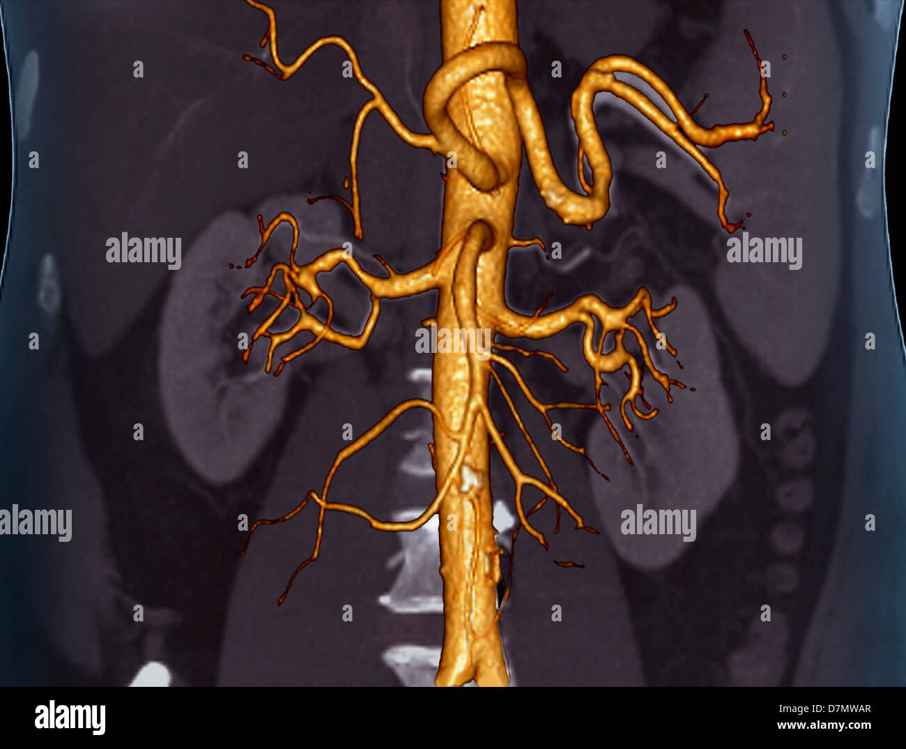 Normal Abdominal Aorta Ct Scan