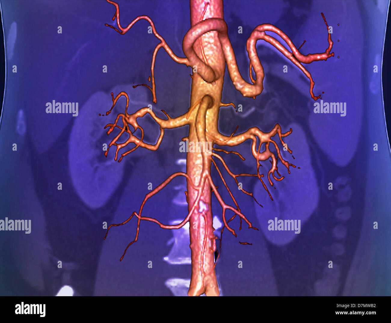 Тромбоз брюшной. Кт ангиография почечных артерий. Атеросклероз мезентериальных аорты. Аневризма почечной аорты.