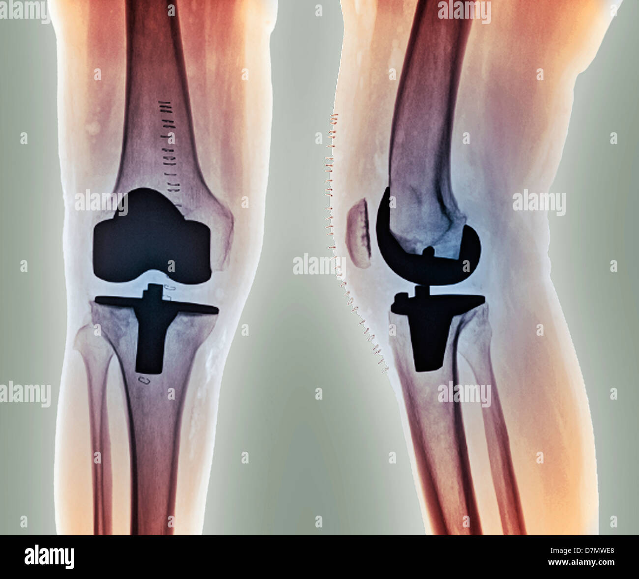 knee joint replacement devices