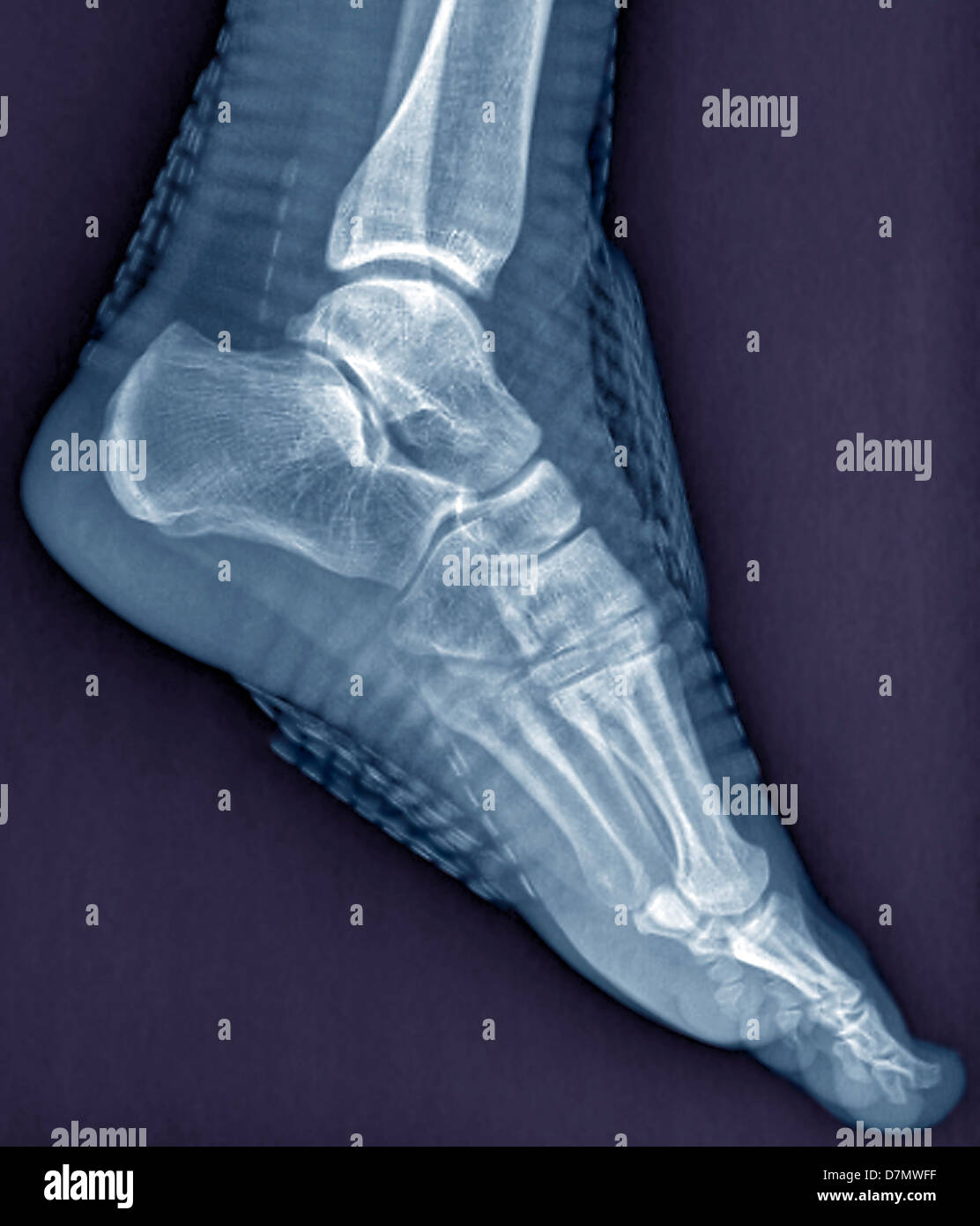 Healthy ankle joint, X-ray Stock Photo