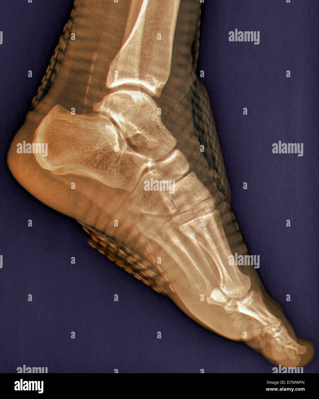 Healthy ankle joint, X-ray Stock Photo - Alamy
