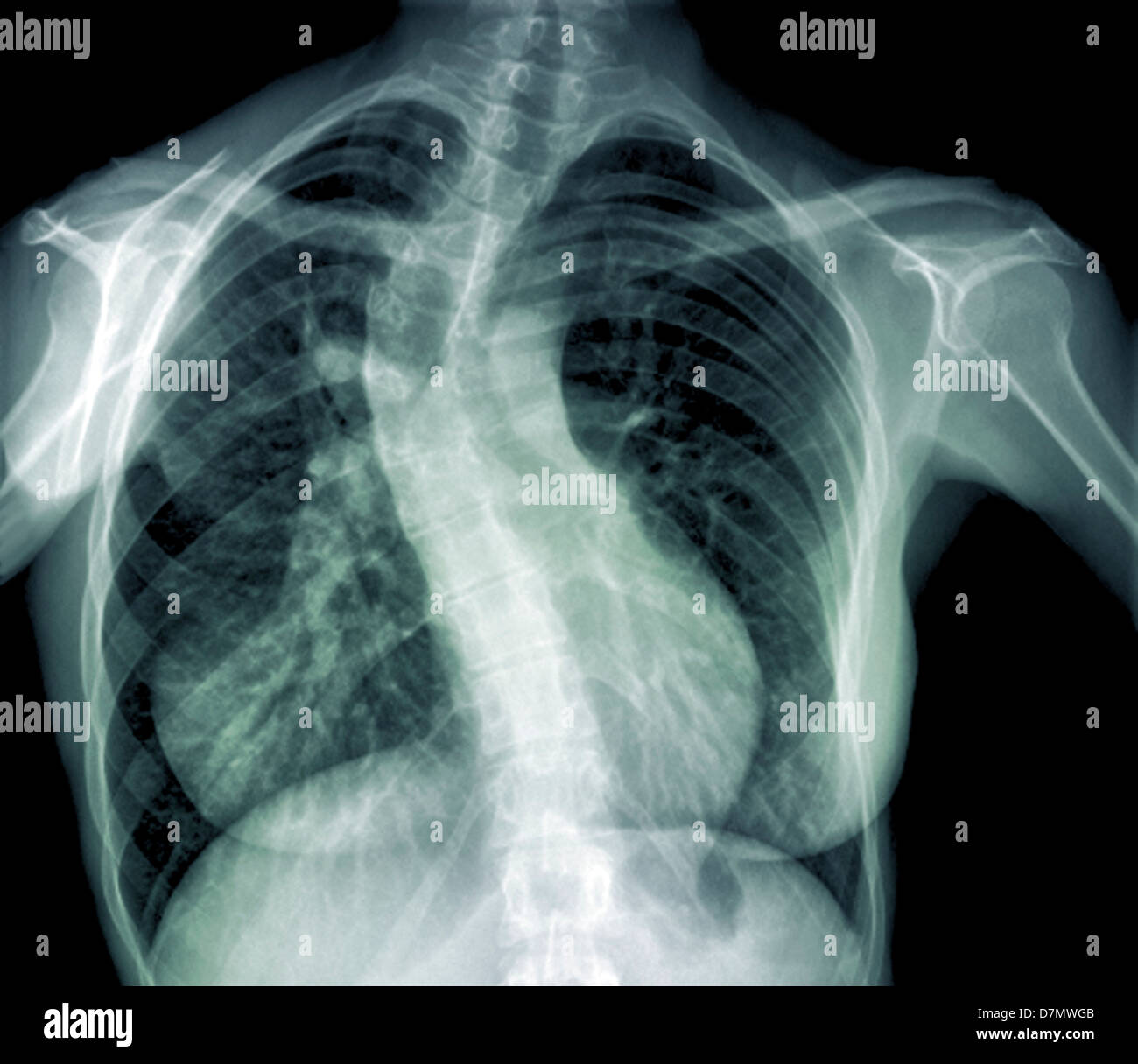 Scoliosis Of The Spine X Ray Stock Photo Alamy