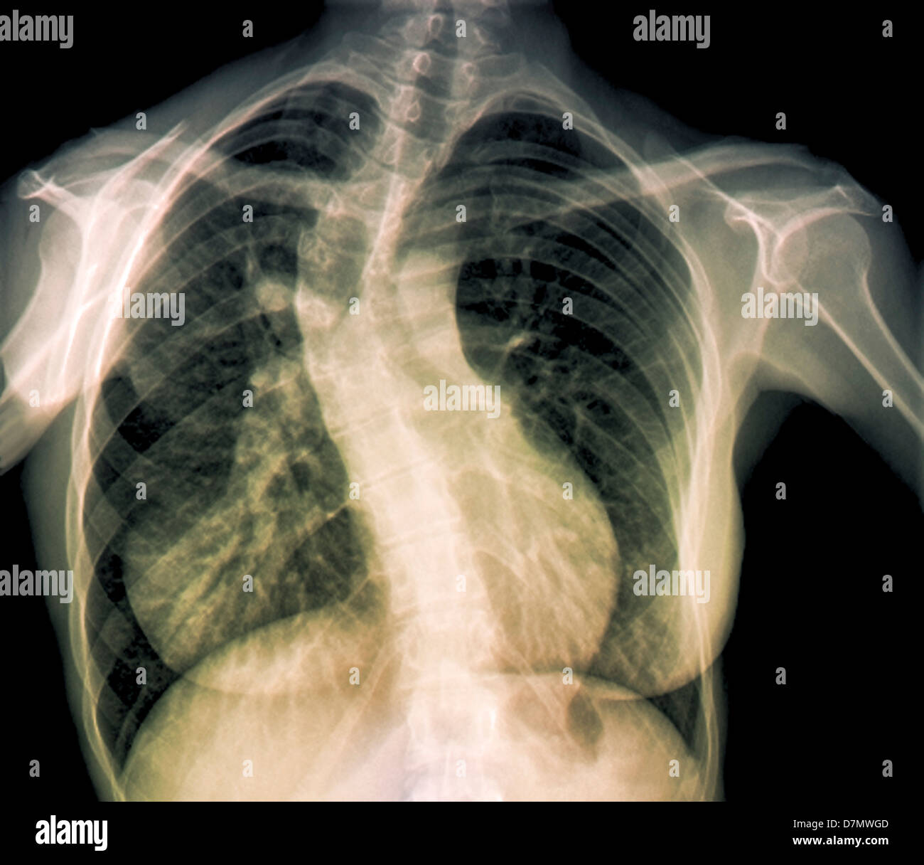 Scoliosis of the spine, Xray Stock Photo Alamy