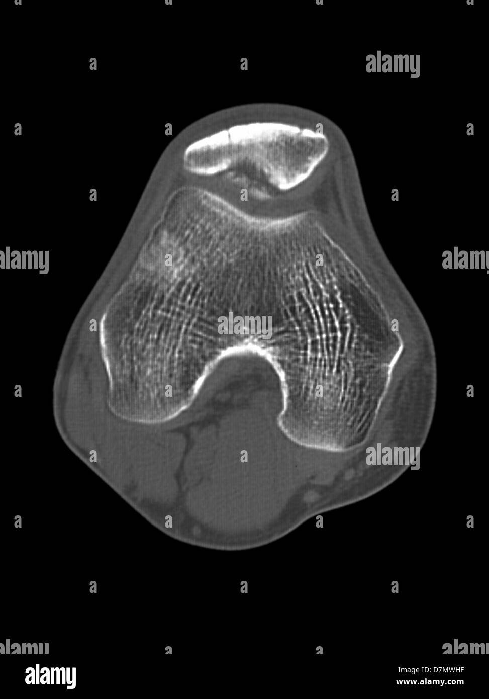 Knee disease, CT scan Stock Photo