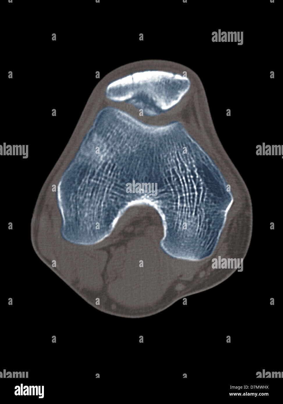 Knee disease, CT scan Stock Photo