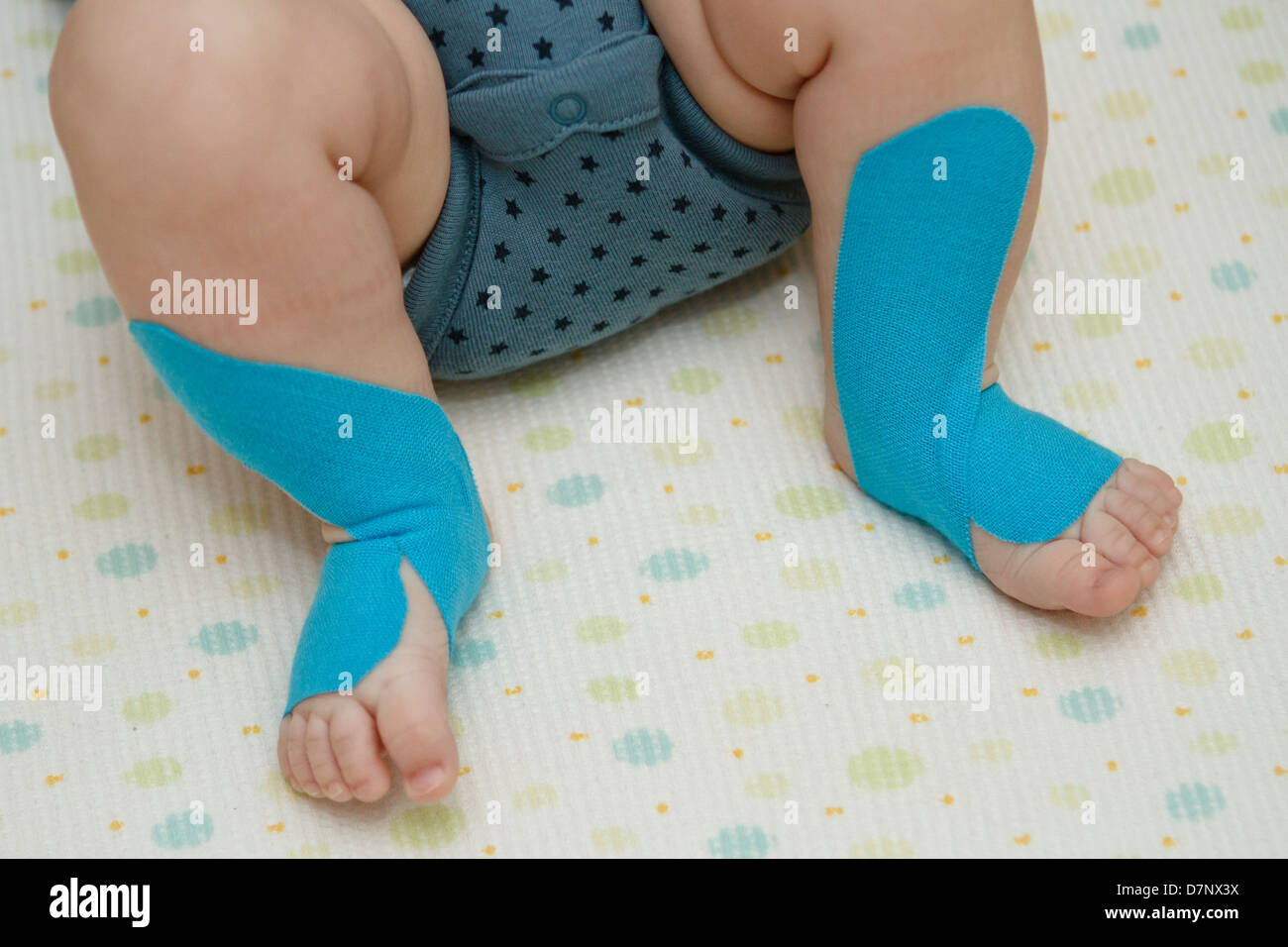 Kinesio tape on baby boy legs Stock Photo 56415182 Alamy