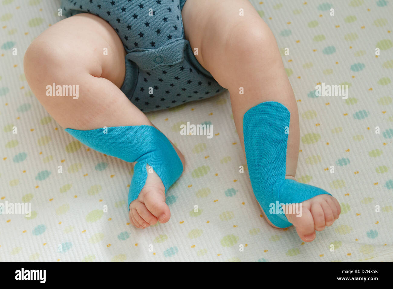 Kinesio tape on baby boy legs Stock Photo Alamy