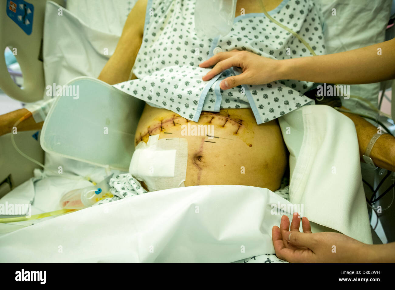 Medical staff attend to a patient who has had stitches in the abdominal area following surgery, on an intensive care unit. Stock Photo