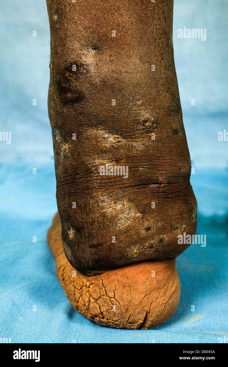 Posterior view of Eumycetoma of the left ankle. Stock Photo