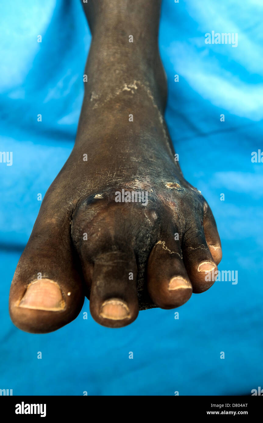 Actinomycetoma on the left foot of a 47 year old male. Stock Photo