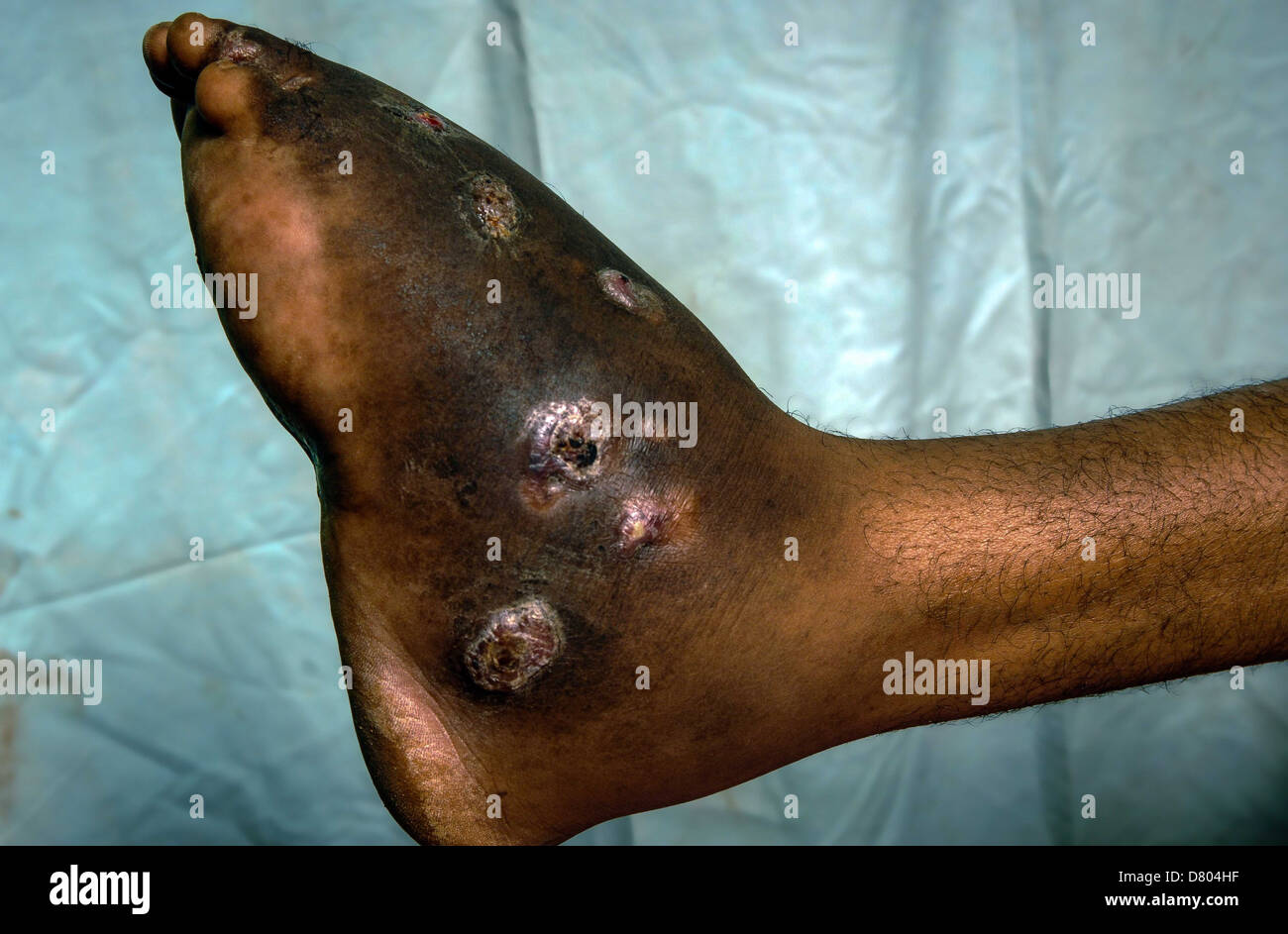 Close up of mycetoma on the left foot of a young male patient. Stock Photo