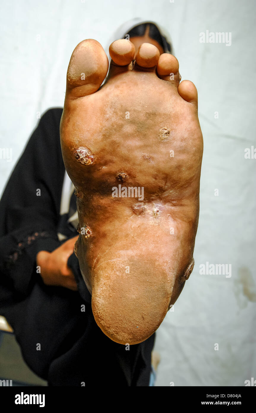 Close up of Mycetoma on the left sole of a young female. Stock Photo